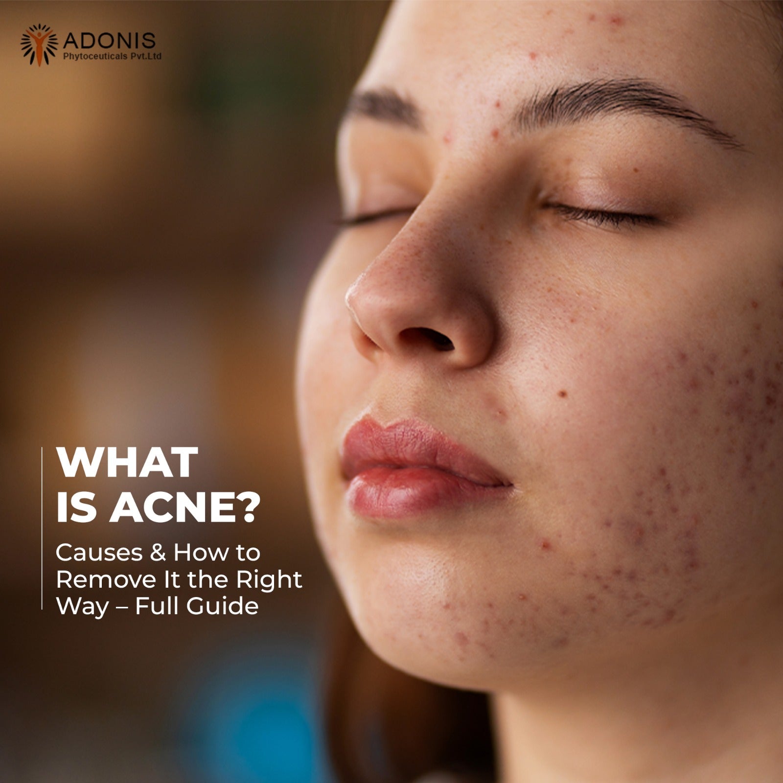 What Is Acne? Causes & How to Remove It the Right Way – Full Guide